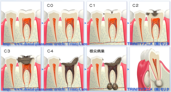 虫歯の進行について
