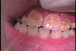 前歯に虫歯がある症例術前
