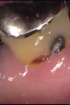 歯と歯ぐきの境目に虫歯がある症例術前