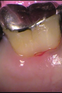 歯と歯ぐきの境目に虫歯がある症例術後